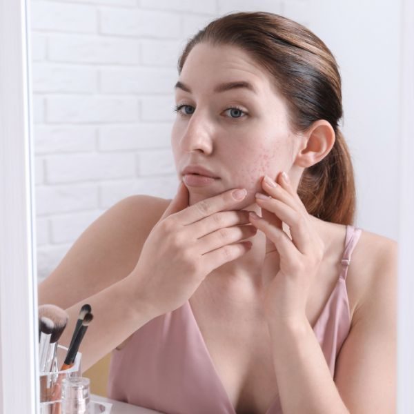 Woman with hormonal acne picking at her face.